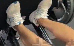 Nam thanh niên 23 tuổi suy thận cấp sau khi tập gym, chỉ số tổn thương cơ tăng gấp 100 lần