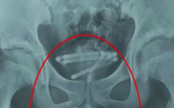 Chàng trai 28 tuổi đau bụng dưới, muốn đi tiểu nhưng không thể đi được, bác sĩ kiểm tra phát hiện 1 thứ dài 25cm bên trong