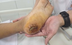 Bệnh viện Bạch Mai cảnh báo: Nhiều người đang phải nhập viện thở máy vì 1 căn bệnh do chủ quan vết thương nhỏ