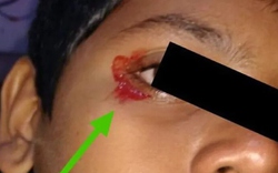 Bé trai 11 tuổi khóc ra máu khiến bác sĩ kinh ngạc
