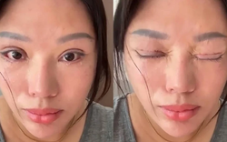Người phụ nữ 6 năm không thể nhắm mắt khi ngủ, lý do phía sau khiến nhiều người bất ngờ