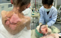 Bé trai 9 tuổi bong tróc da, loét khắp cơ thể, vảy dính kín mắt miệng, nguyên nhân từ 1 loại thuốc thông dụng trong mọi gia đình