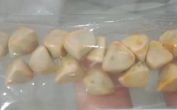 Uống trà đá đều đặn suốt 10 năm, người phụ nữ sốc khi bác sĩ lấy ra thứ "đáng sợ" trong bụng