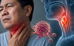 Bác sĩ cảnh báo: 6 DẤU HIỆU bất thường ở cổ họng có thể liên quan đến ung thư, nhiều người nhầm là viêm họng thông thường