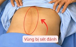 Thoát nguy kịch sau khi bị sét đánh lúc đang lao động