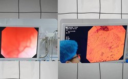 Vì sao cùng là kết quả "bình thường" nhưng nội soi đường tiêu hóa bằng máy phóng đại 520 lần đáng tin cậy hơn 135 lần?