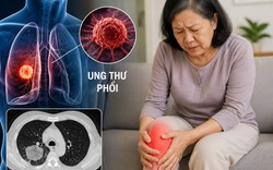 Bác sĩ cảnh báo: 3 DẤU HIỆU quan trọng của ung thư phổi, nhiều người chủ quan vì nghĩ đau chân do thời tiết