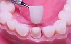 Vì sao nhiều người bọc răng sứ xong bị hôi miệng?