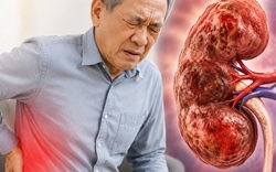 Bác sĩ chỉ: 6 DẤU HIỆU cảnh báo suy thận, nhưng dễ bị người Việt nhầm với vấn đề tuổi tác và mệt mỏi