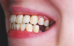 Vì sao nhiều người mất răng nhưng không chịu trồng?