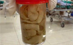 Phát hiện sán dây 1,2m trong ruột người đàn ông: Bác sĩ chỉ ra thói quen ăn uống vạn người mê là nguyên nhân