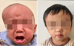 Mỗi ngày kéo giãn hộp sọ 1mm, bác sĩ thay đổi gương mặt trẻ mắc dị tật hiếm gặp
