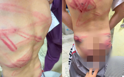 Bé trai 9 tuổi nhập viện với nhiều vết bầm tím: Lời khai của người cha sau khi thừa nhận đánh con gây phẫn nộ