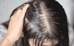 Tưởng stress vì thi cử nên rụng tóc, cô gái 22 tuổi phát hiện căn bệnh đang âm thầm đang phá hủy thận