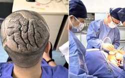 Người đàn ông 23 tuổi có da đầu dày, gấp nếp như bộ não và sự thật bất ngờ