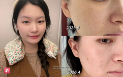 Từng khổ sở vì nám sau sinh, tôi tìm lại làn da sáng khỏe nhờ 3 bước chăm sóc đơn giản