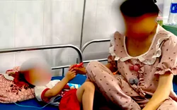 Triệu tập người cha dượng đánh tím mặt con riêng của vợ