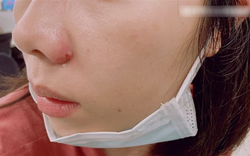 Nặn mụn quanh miệng, người phụ nữ bị sưng tấy từ môi lên tận sống mũi, bác sĩ cảnh báo: Sai lầm ở 1 điểm!