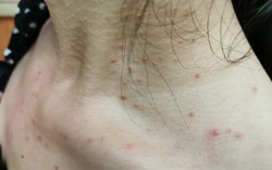 Cảnh báo: Các bệnh ung thư rất dễ "ngụy trang" dưới hình dạng của 4 loại mụn này
