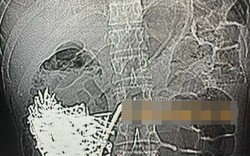 Người đàn ông đau bụng, nôn liên tục, bác sĩ choáng khi thấy dạ dày chứa thứ nặng hơn 1 kg