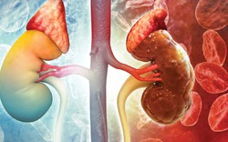 Cảnh báo 'mắt xích' hàng đầu âm thầm gây suy thận: Thật may vì có 3 thói quen 'cứu cánh'