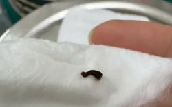Đỉa chui vào mắt khi rửa mặt bằng nước suối