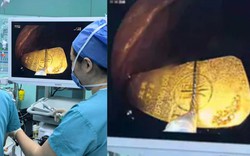 Bé gái 5 tuổi nuốt thỏi vàng 50gr, các bác sĩ nội soi gắp thành công