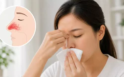 Chảy máu cam có phải dấu hiệu của ung thư?