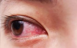 Đau mắt đỏ mùa mưa: Chủ động phòng bệnh, ngăn ngừa lây lan