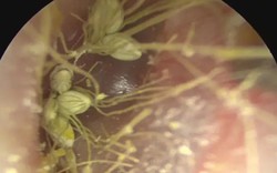 Bé 1 tuổi thường xuyên gãi tai, bác sĩ sốc nặng khi phát hiện thứ bên trong