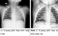 Phát hiện dị vật "bị bỏ quên" hơn 1 tháng trong phế quản bé trai 3 tuổi