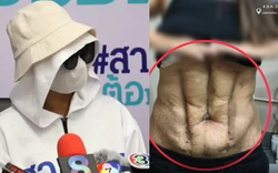 Phần bụng biến dạng của người phụ nữ sau ca phẫu thuật "cơ bụng số 11" giá rẻ tại phòng khám nổi tiếng Thái Lan