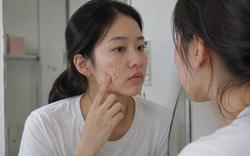 Mụn không chỉ là câu chuyện tuổi dậy thì