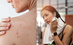 Chăm skincare kỹ nhưng lưng vẫn nổi đầy mụn? Bác sĩ da liễu chỉ ra 1 thói quen nhiều người mắc phải khiến mụn mãi không dứt