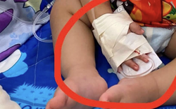 Bé 1 tuổi phải phẫu thuật nối ngón tay nghi do nhân viên y tế cắt trúng trong lúc tháo kim truyền