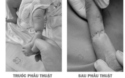Hy hữu: Trẻ sơ sinh bị vòng xơ thắt nghẹt cẳng chân từ trong bụng mẹ, phải phẫu thuật khi mới 12 giờ tuổi