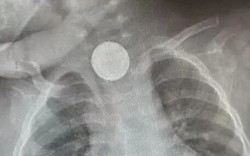Bé gái hơn 1 tuổi cứ ăn là nôn, bố mẹ sốc khi biết sự thật