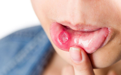 Miệng hay bị nhiệt, khô vào mùa thu, ăn gì để “giải cứu”? Những thực phẩm quen thuộc có thể khiến bạn bất ngờ