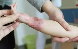 Bé trai 4 tuổi bị bỏng nước sôi 100°C, cách sơ cứu của người mẹ được bác sĩ khen ngợi
