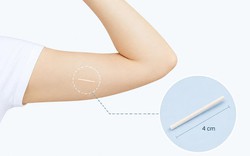 Cẩn trọng với "dịch vụ" cấy que tránh thai tại nhà