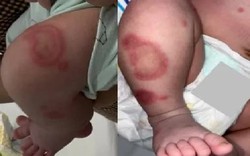Lupus sơ sinh ở trẻ 26 ngày tuổi, cảnh giác biến chứng tim