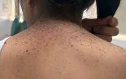 Khô da sắc tố ở trẻ: Cảnh báo nguy cơ ung thư da sớm