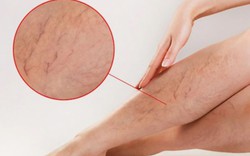 Tưởng mỏi chân do đứng bán hàng, đi khám phát hiện tĩnh mạch hiển suy nặng