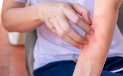 Nếu bạn có hai vùng da bị ngứa dai dẳng trên cơ thể, hãy cảnh giác vì đó có thể là dấu hiệu của ung thư gan