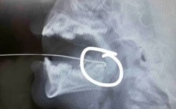 Bất cẩn khi đùa giỡn, bé 13 tháng tuổi bị ăng ten đồ chơi xuyên qua lưỡi