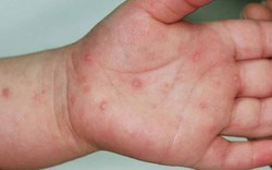 Tp.HCM ghi nhận số ca tay chân miệng tăng 47% trong một tuần