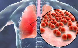 Bệnh phổi kẽ: Chuyên gia cảnh báo rất nguy hiểm nhưng ít được biết đến