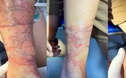 Cảnh giác sứa đốt khi tắm biển