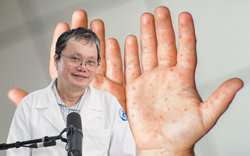 Danh sách câu hỏi vắc-xin tay chân miệng được các gia đình quan tâm nhất lúc này: Có nên tiêm không? Chỉ phòng EV71 thì có đủ?