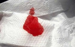 Đi khám vì ra máu sau quan hệ, người phụ nữ 45 tuổi phát hiện mắc cùng lúc 2 bệnh ung thư
